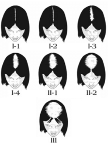 Alopecia feminina